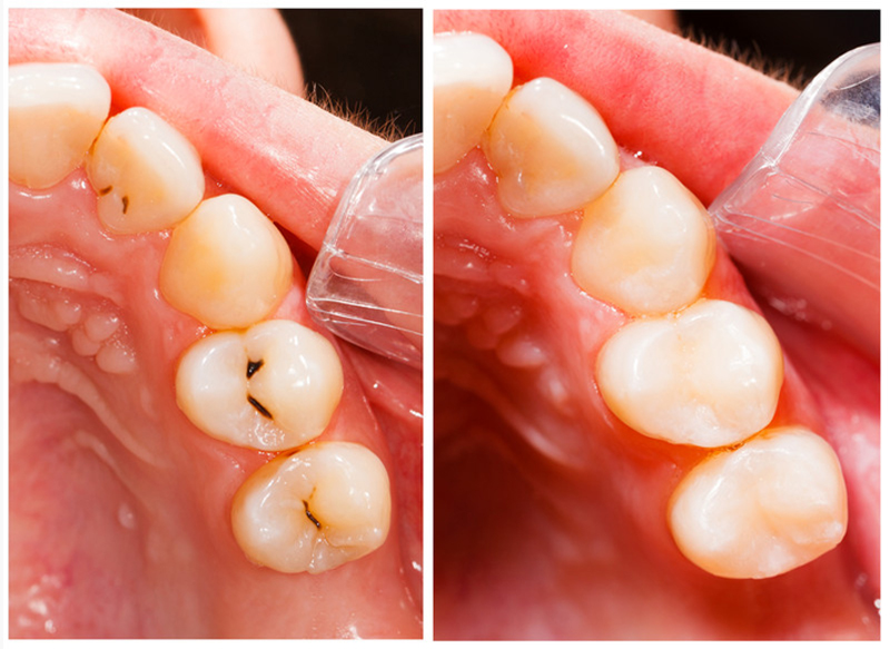 Dental fillings service image